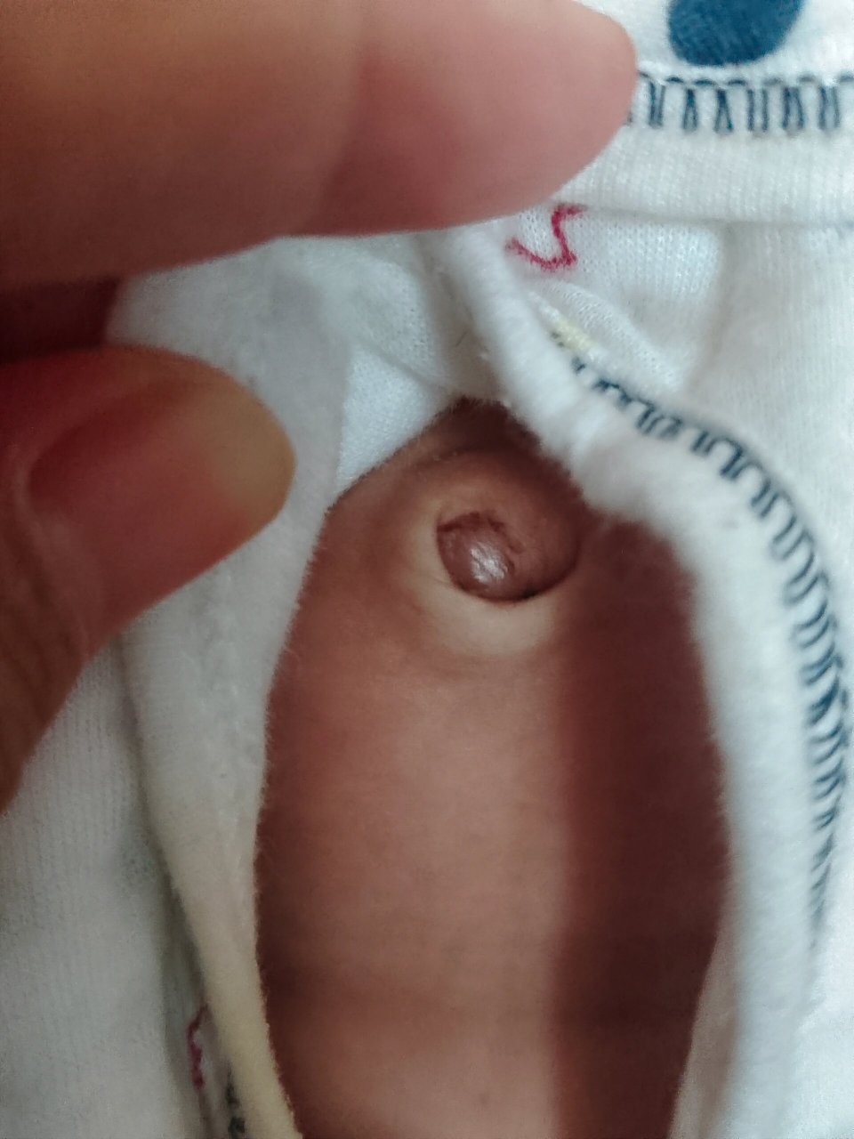 宝宝的肚脐凸出来了怎么办呀 宝宝45天了 最近有胀气,今天突然发现