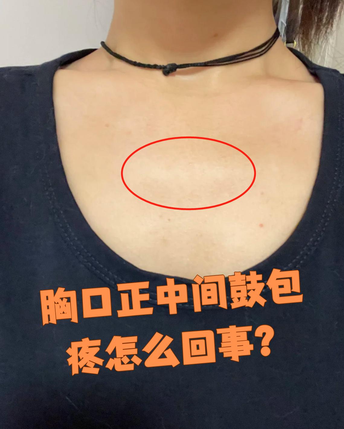 胸口正中间鼓包疼可能和皮脂腺囊肿,骨肿瘤,脂肪瘤这些情况有关