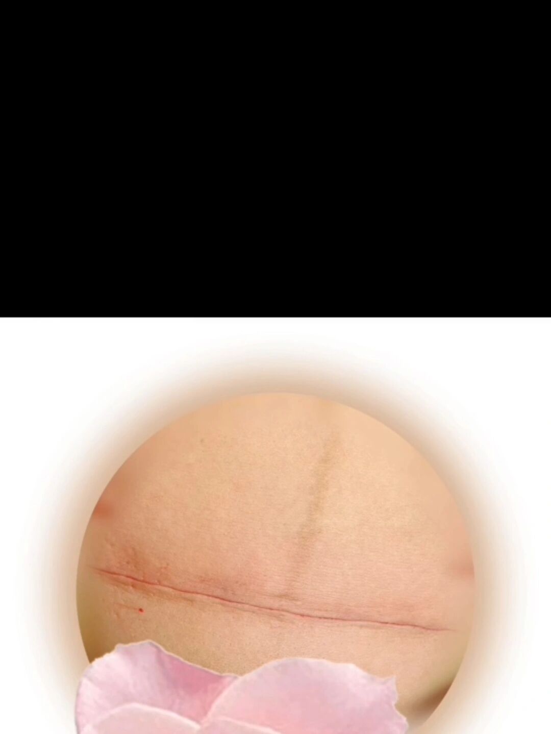 剖腹产刀口 这是刚缝完的样子,这种技术算怎么样?