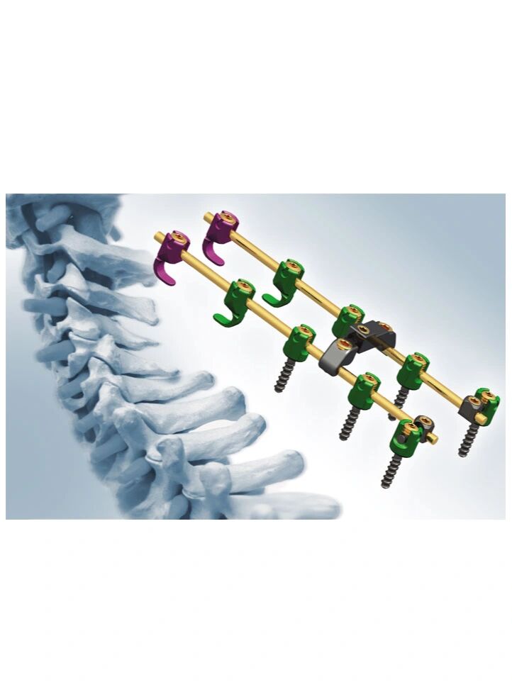 脊柱侧弯手术矫正的内固定器械是不需要取出来的.