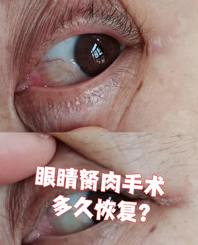 眼睛胬肉手术的恢复时间一般需要1个月左右