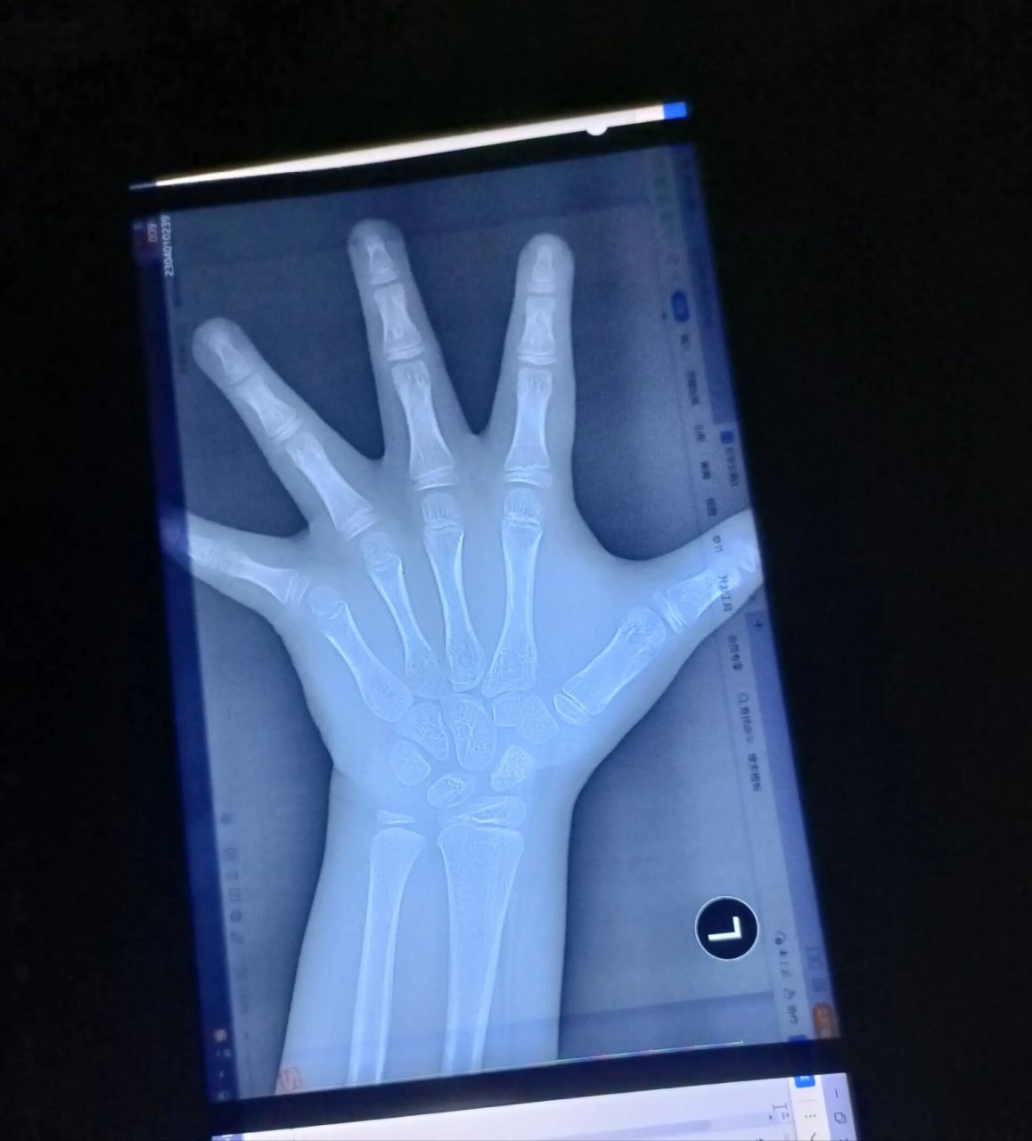 9岁女孩,身高126骨龄正常吗?拜求各位大神