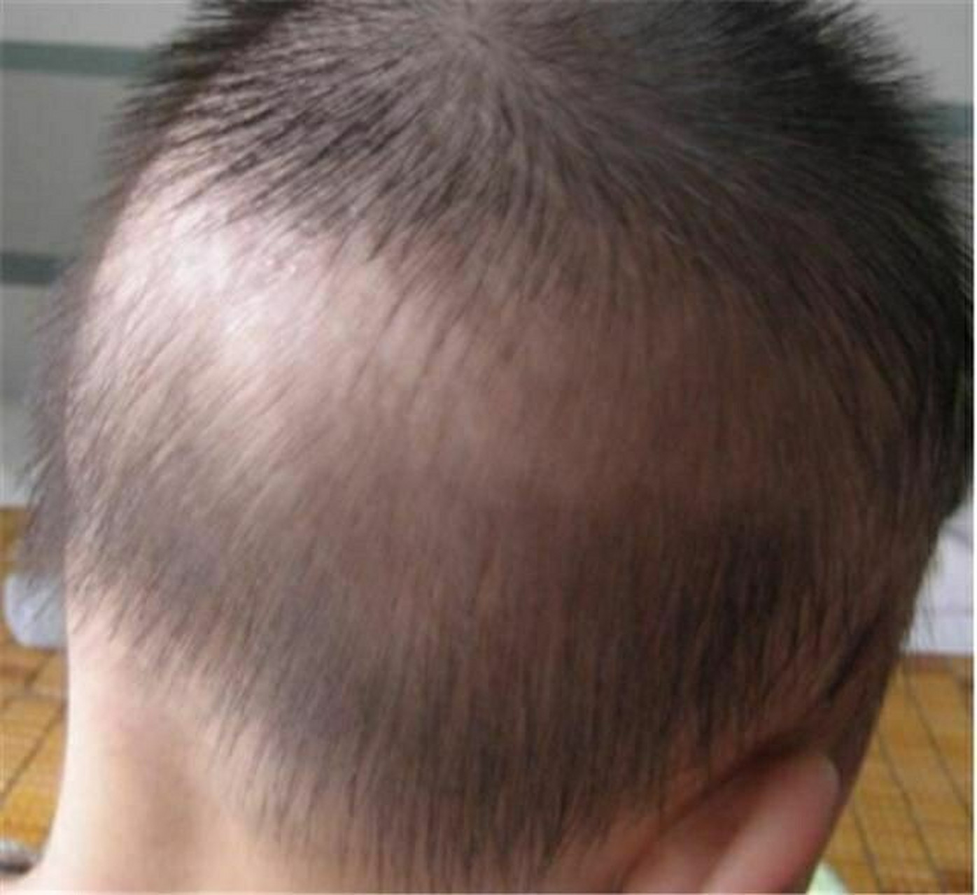 婴幼儿后脑勺头发稀少或者缺一块头发是? 什么是婴幼儿枕秃?