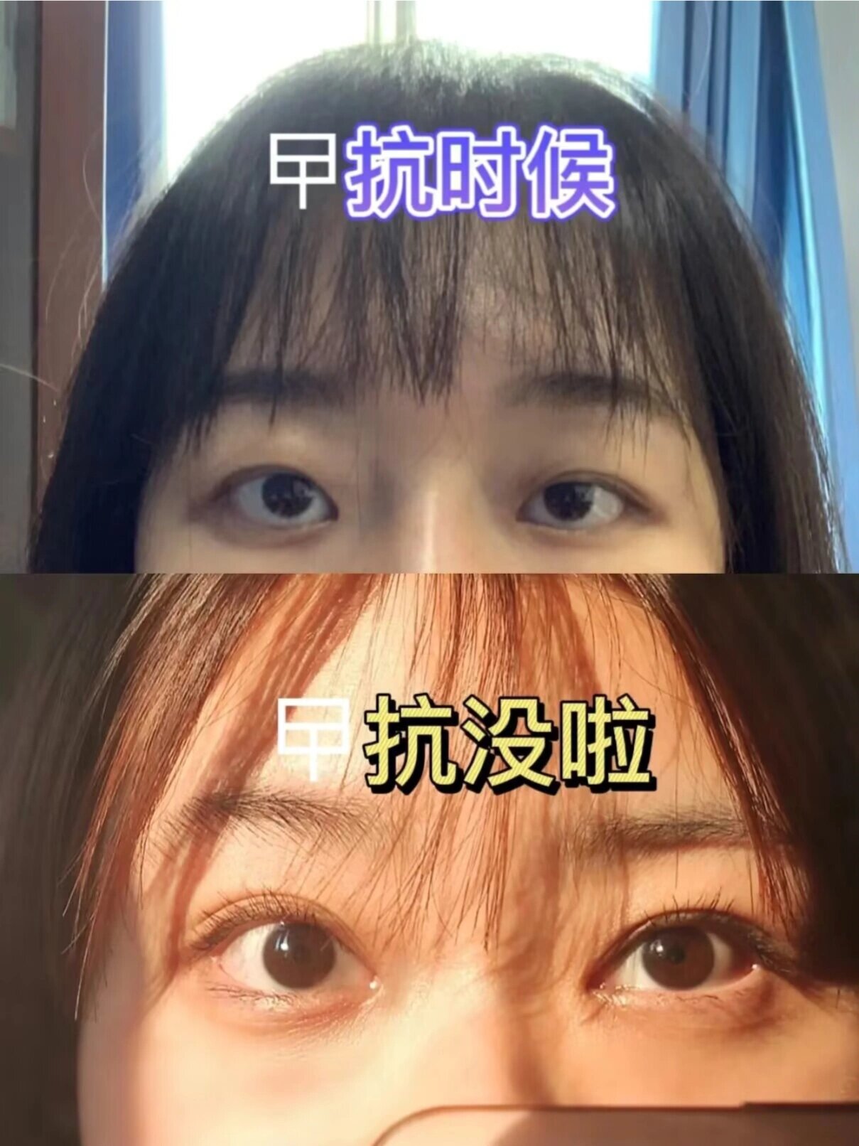 甲亢患者,出现眼突怎么办?