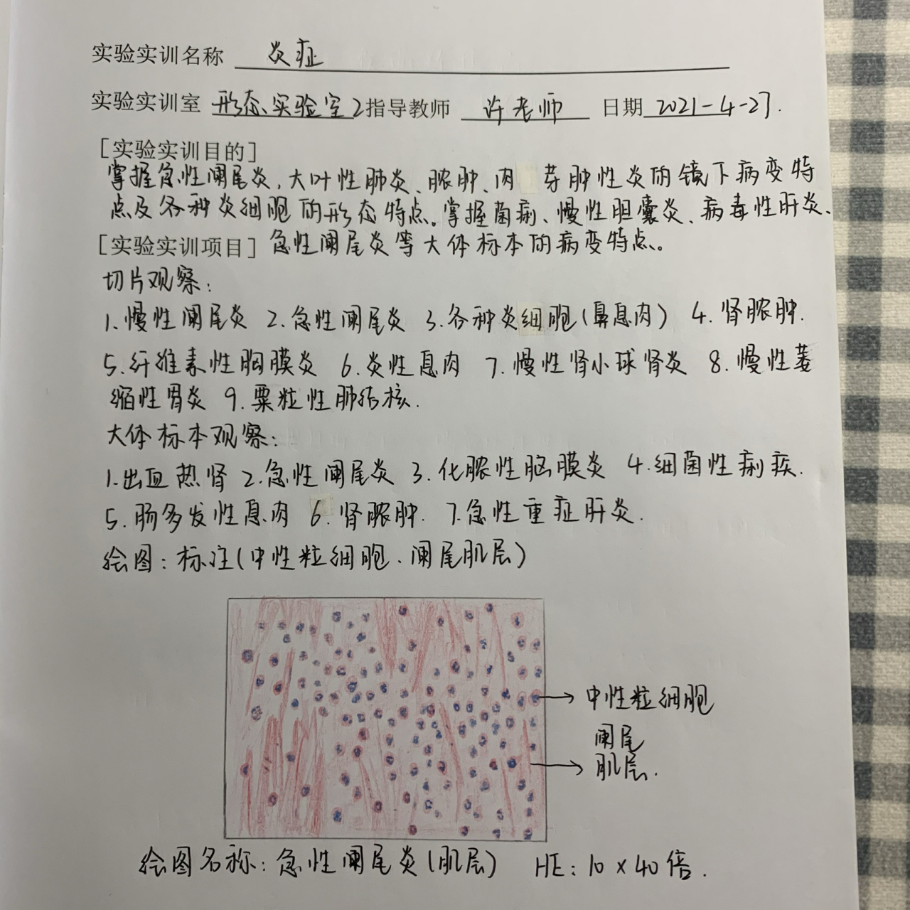 急性阑尾炎(肌层)绘图