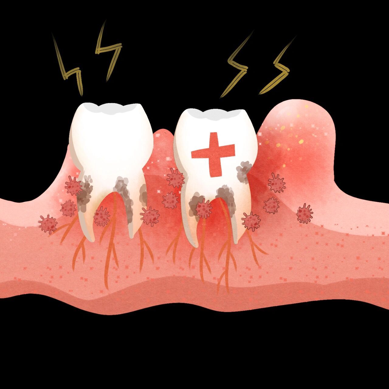 牙龈炎的原因和治疗方法 牙龈炎 牙龈炎是一种轻度的牙周病形势,特征
