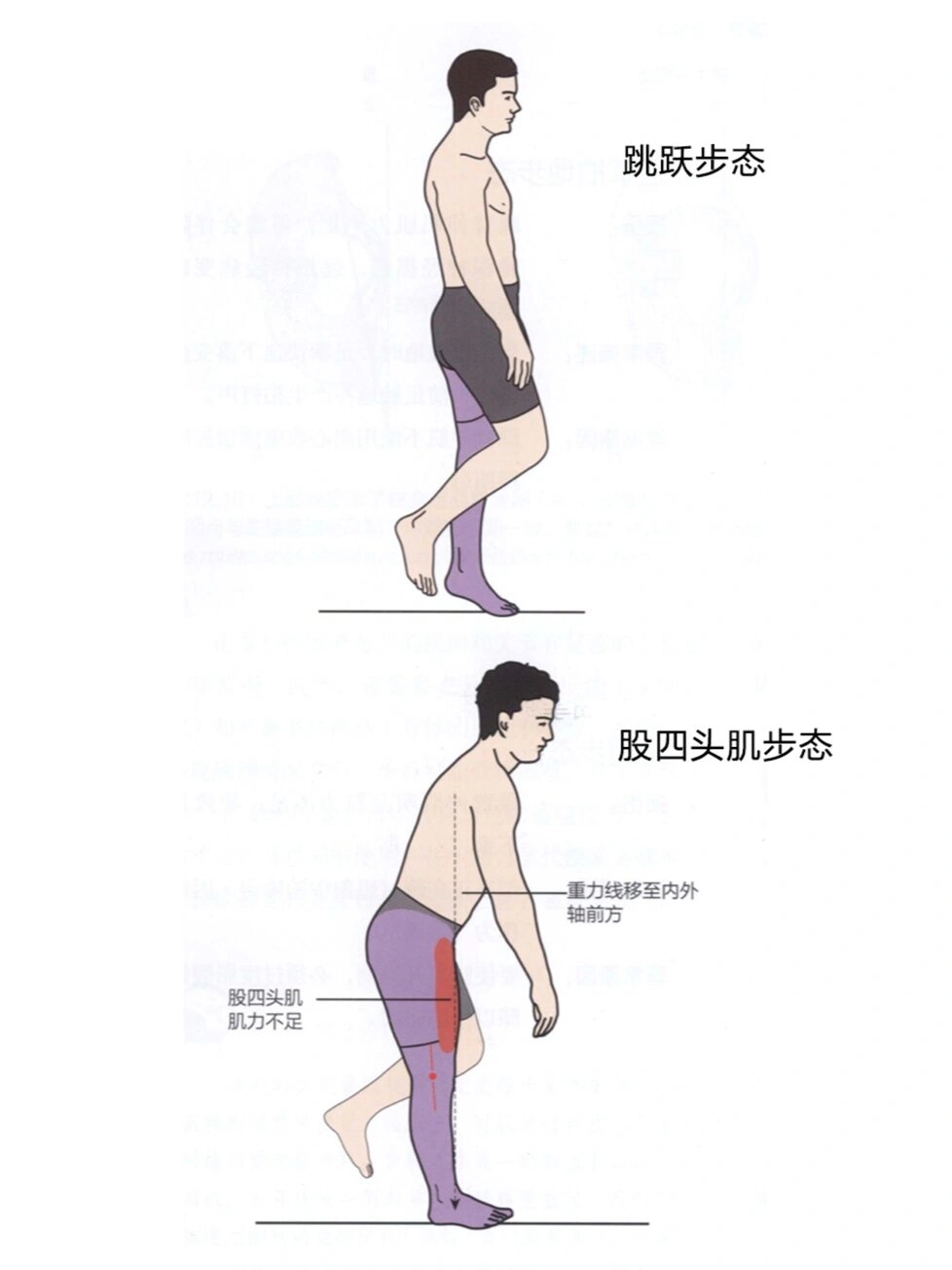 剪刀步态肌肉图片