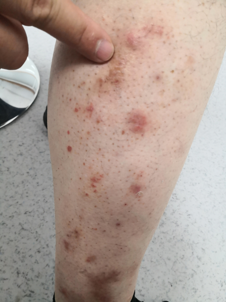 四肢散发鳞屑性斑点斑块症状.考虑点滴型银屑病症状#银屑病##牛皮癣