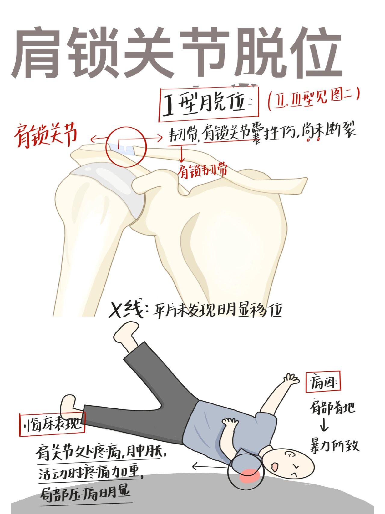 锁骨肩峰端图片图片