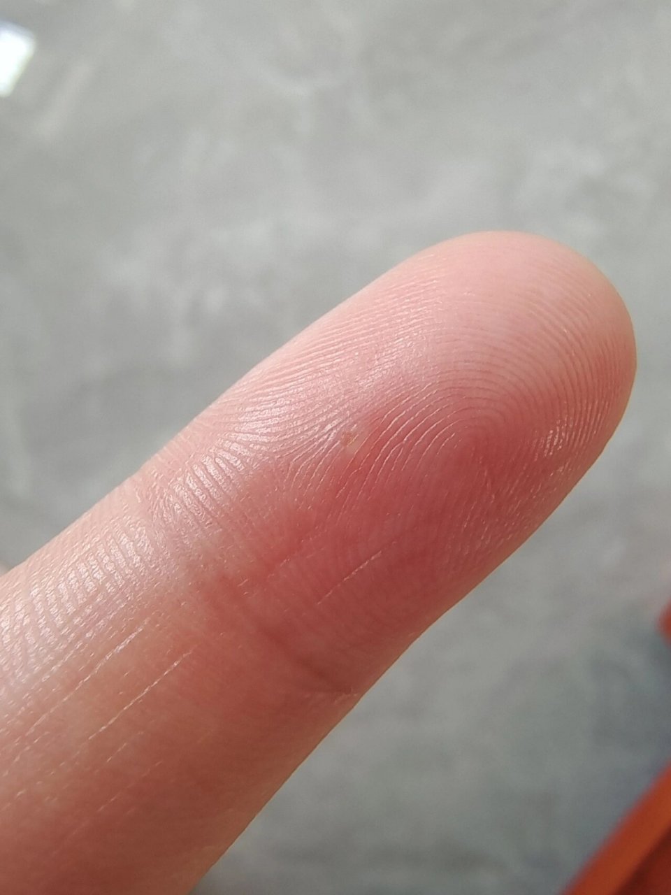 手指上长了个小疙瘩,不知道是啥 像个硬茧子 扣一下有点点疼