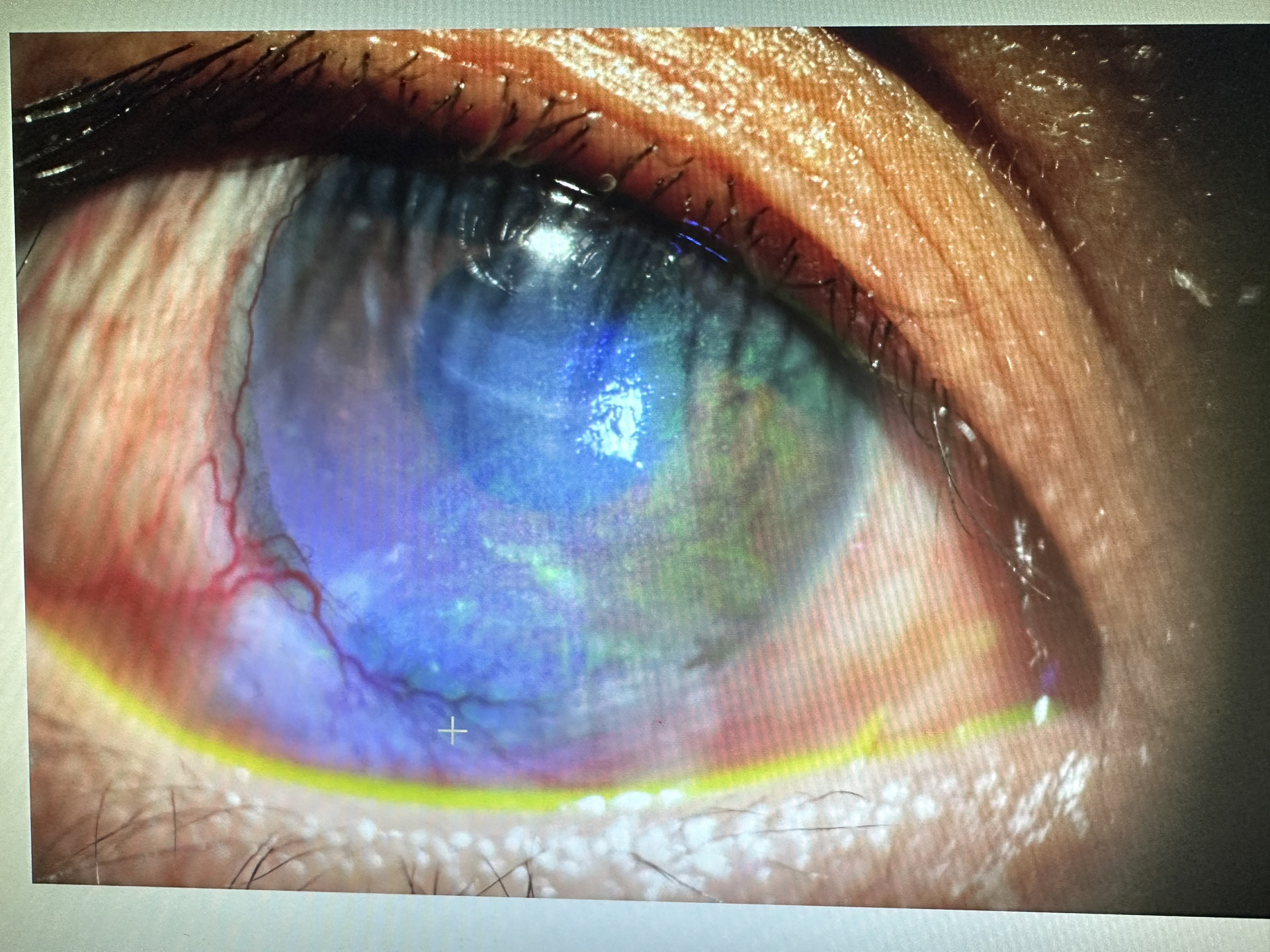 刺痛的眼睛～角膜上皮大面积脱落 严重的干眼会导致角膜上皮脱落,从而