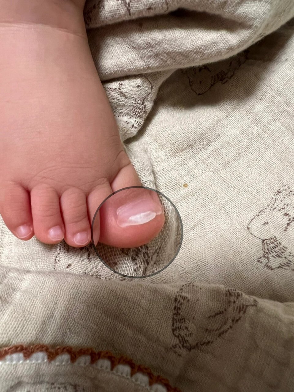 宝宝的脚趾甲又又又又翻了 已经很多次了,也不知道咋办,穿袜子也没用