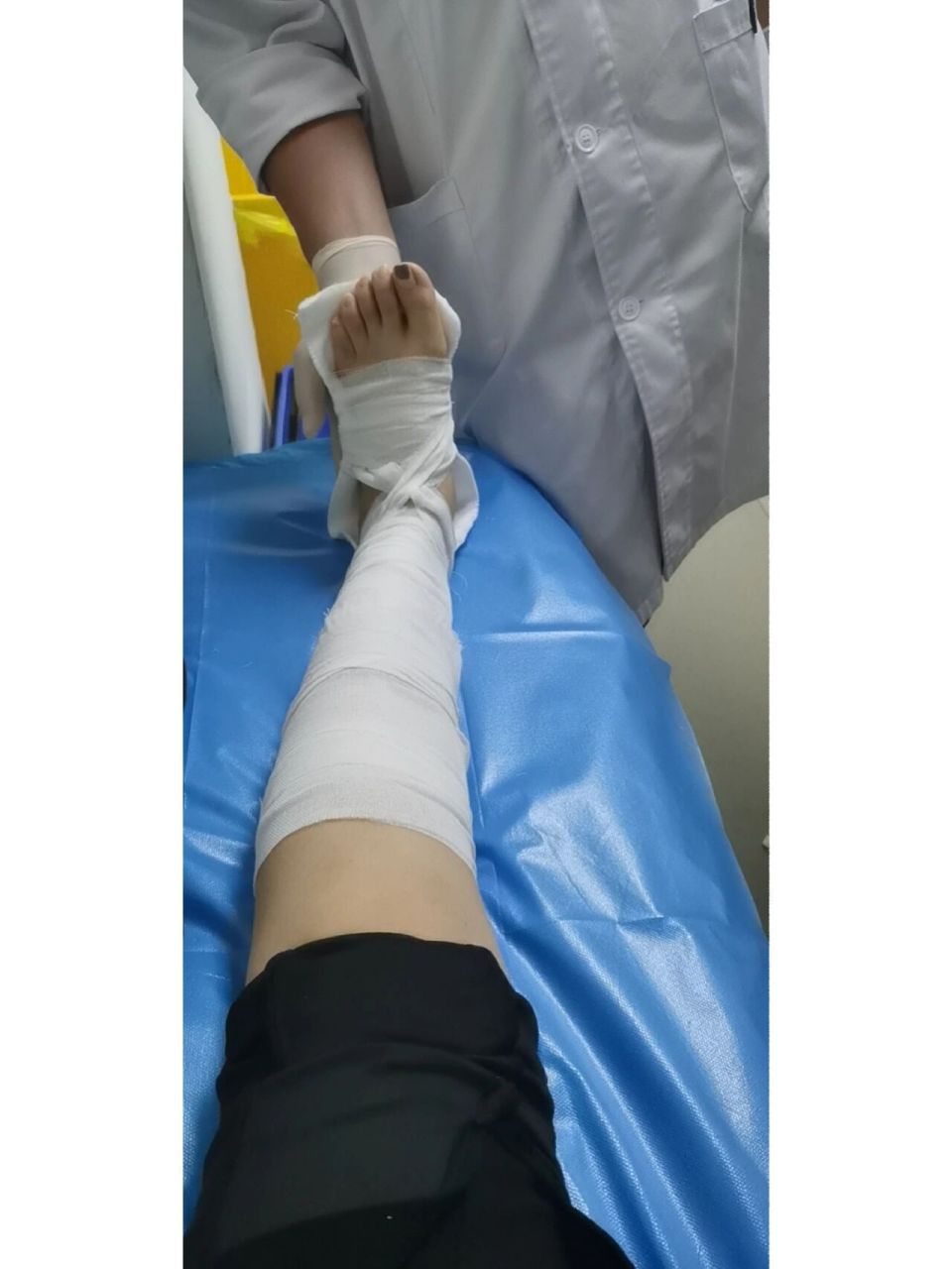 你们打石膏都花了多少钱 刚入职三个月,就把脚崴骨折了 之前第一次