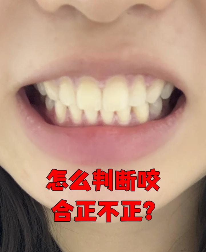 要判断咬合正不正,主要看四个方面:牙列中线,咀嚼效率,牙齿对位沟系