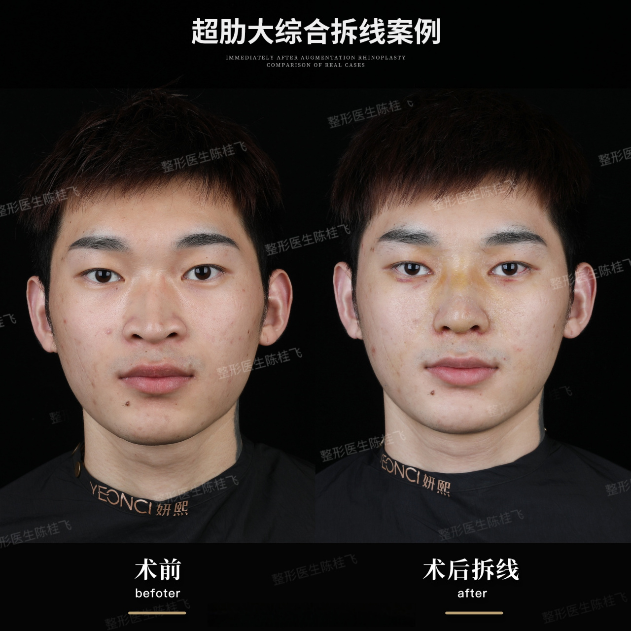 男士肋骨鼻综合案例 术前:鼻梁低,山根低,鼻翼宽,鼻头软骨发育欠佳