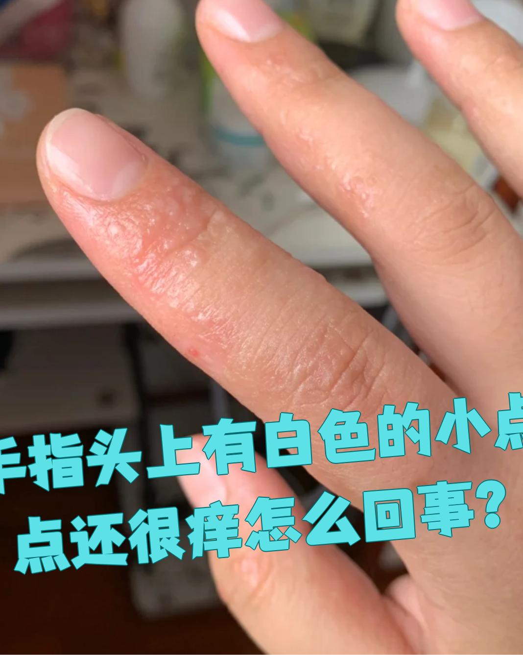手指头上出现白色小点点并且很痒,可能是汗疱疹,湿疹,接触性皮炎