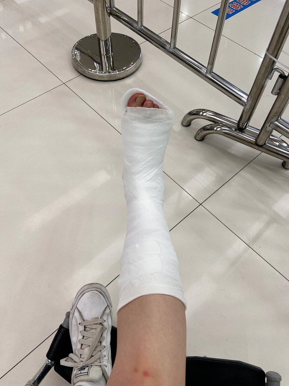 独脚人来看骨科 骨折第四天 今天来看了骨科专家,是一个专门看足踝的