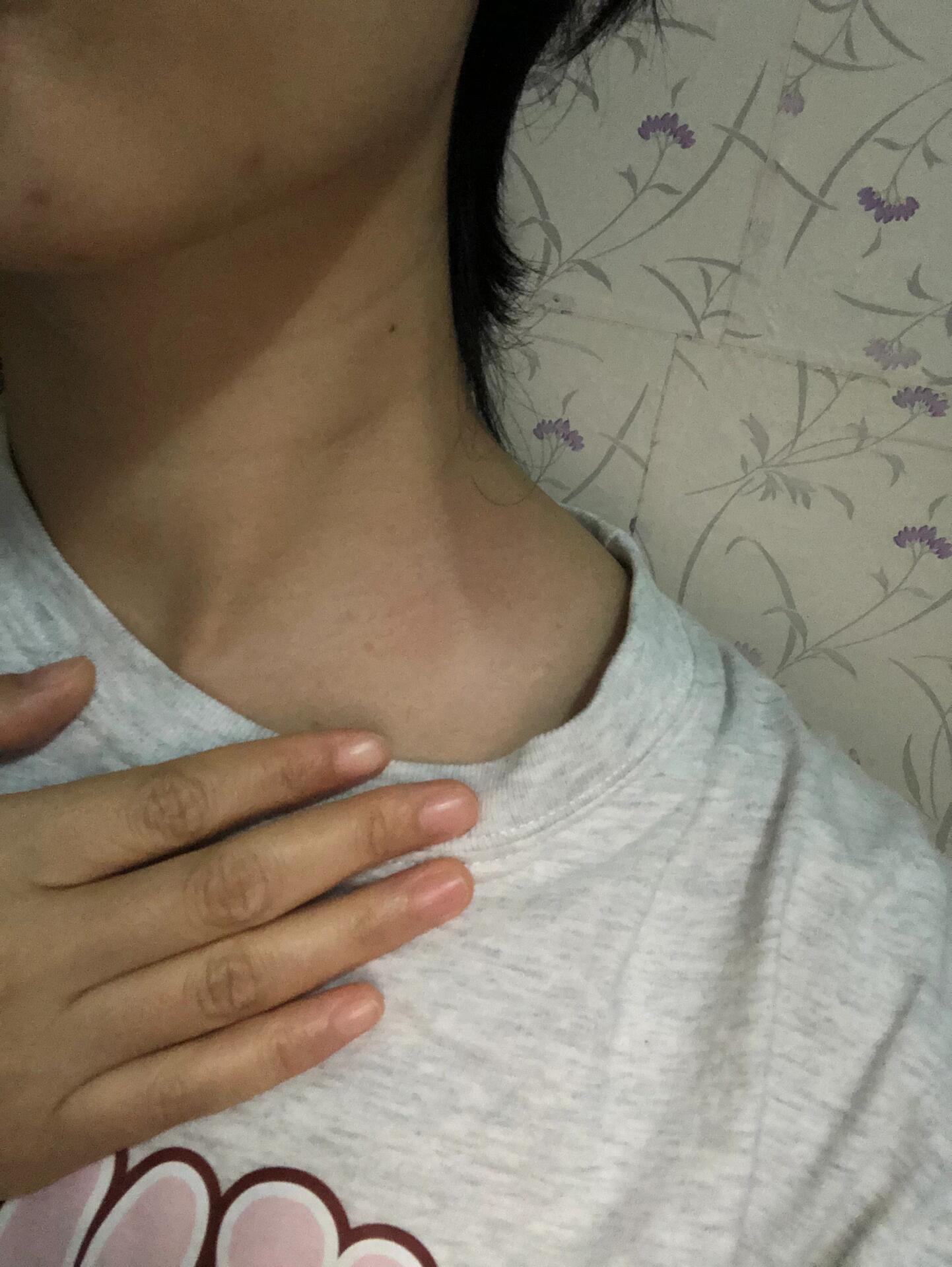 脖子左侧筋变粗 这是怎么了,图一是正常情况,图二是淋巴结吗,不过不疼