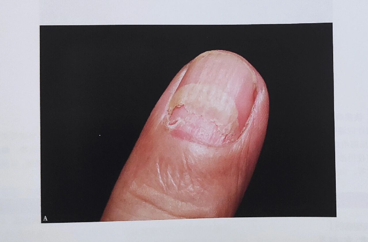 扁平苔藓的指甲盖病损,会变薄,折裂脱落