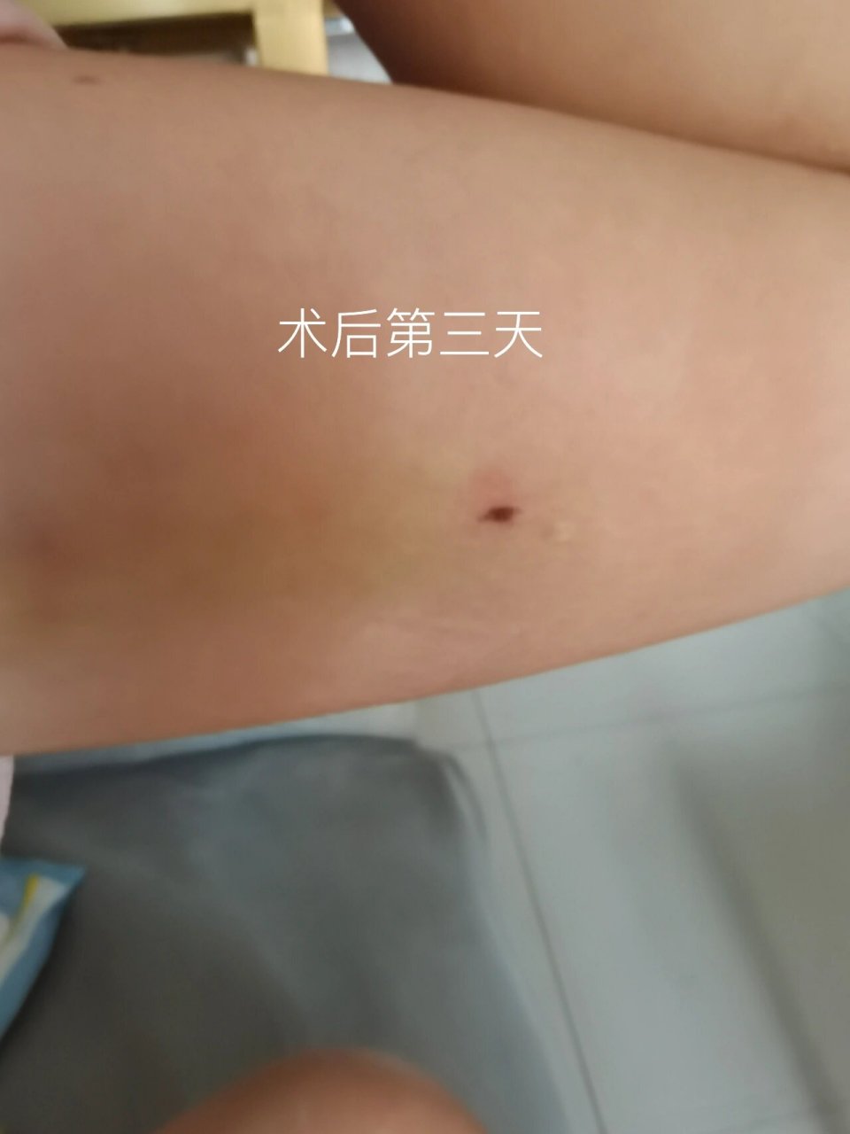 拍照记录了一下过去两天伤口的恢复情况.