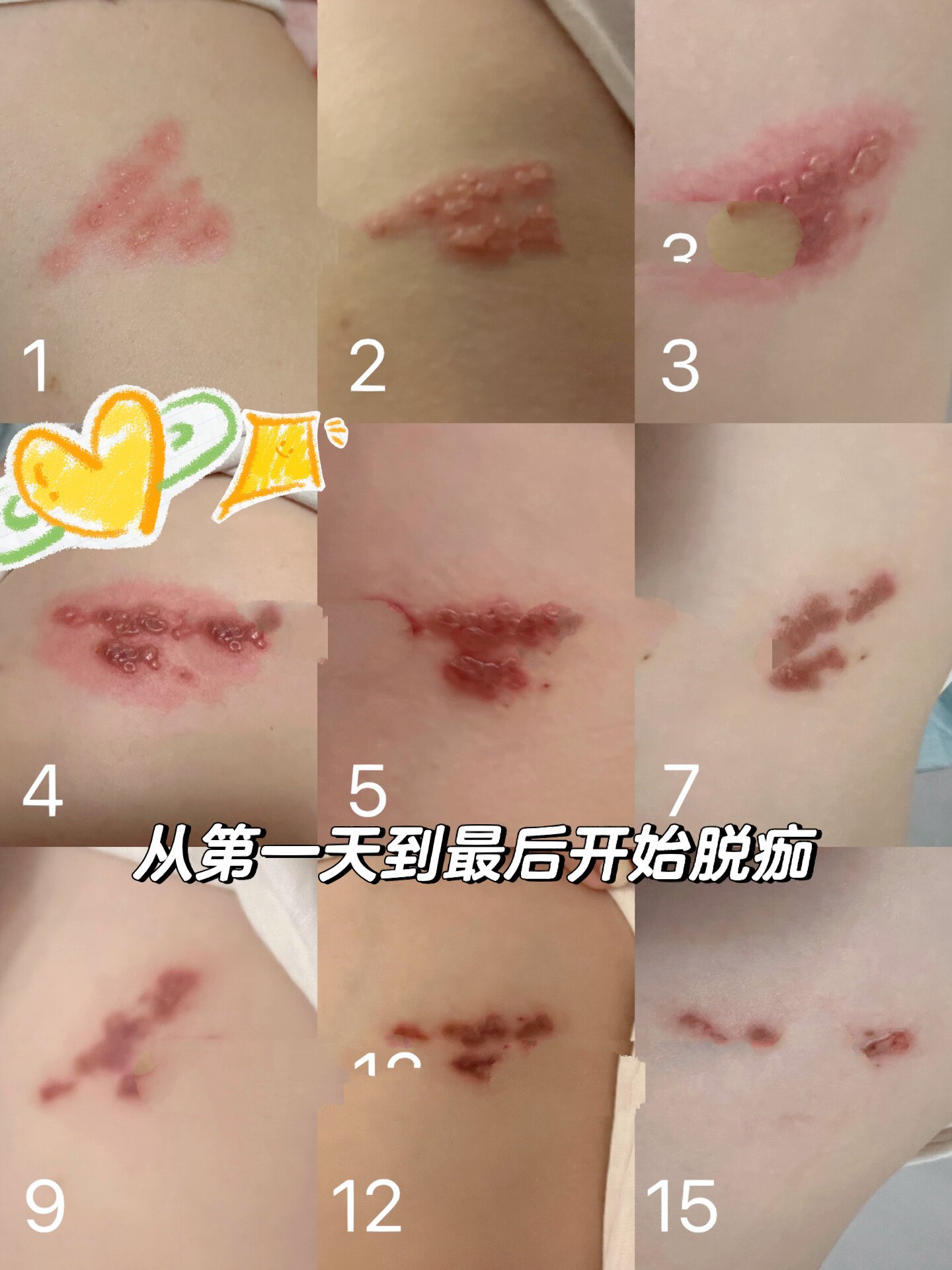带状疱疹治疗过程全分享含时间轴照片!