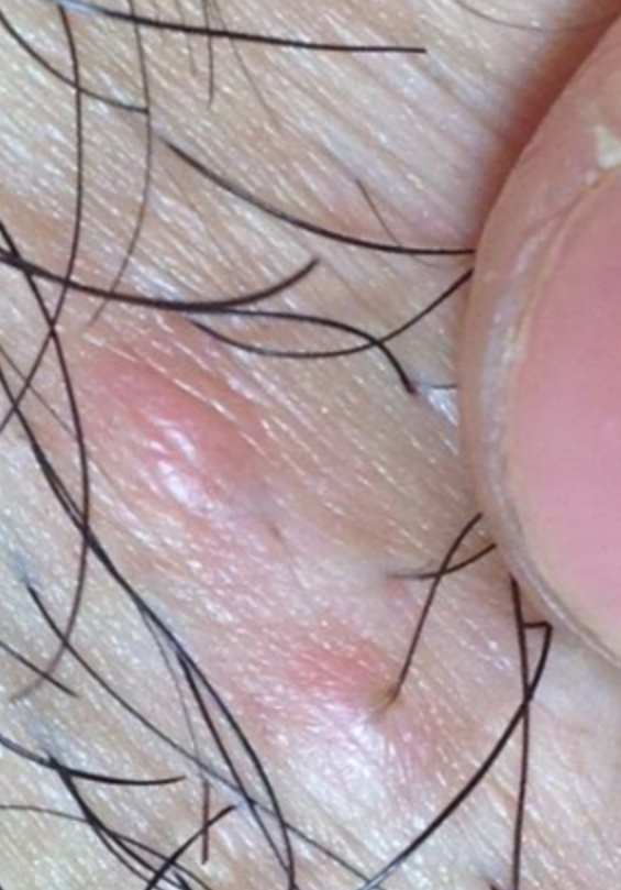 私处长硬疙瘩,伴随瘙痒和疼痛,这种情况通常与外阴部位的病变有关