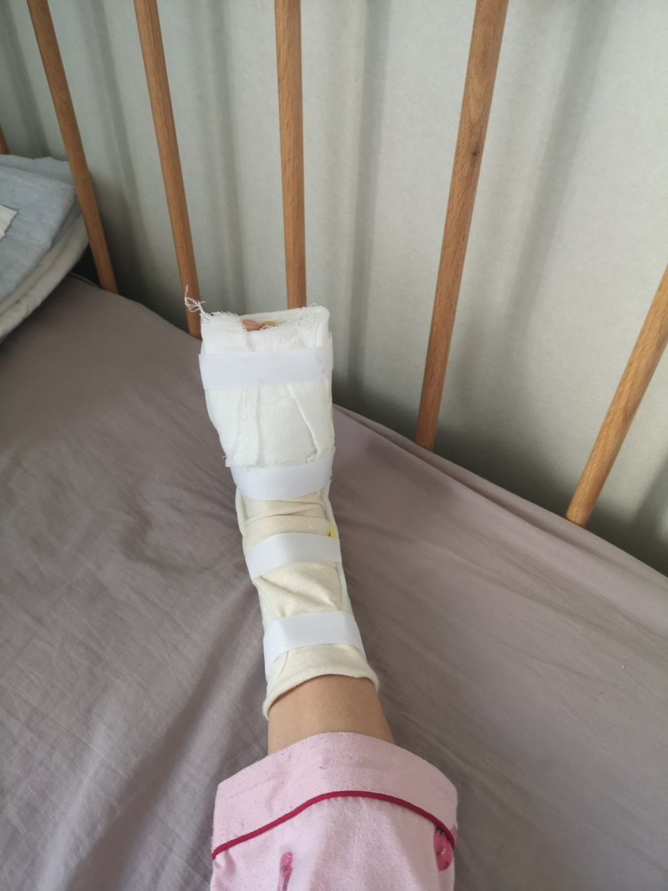 小脚趾骨折 纪念一下,25号下午骨折,26号去的医院,晚上做的手术,植入