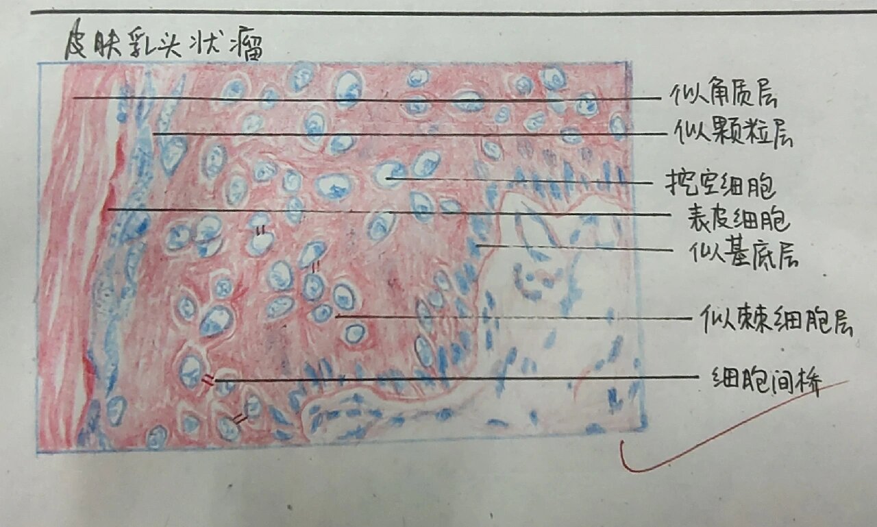 病理实验绘图——皮肤乳头状瘤 【镜片观察】 ①肿瘤呈圆形结节,境界
