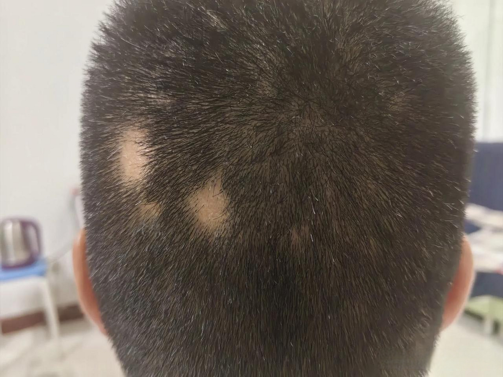 最近不知道什么原因突然头上出现斑秃现象,而且从原来的一大两小变成