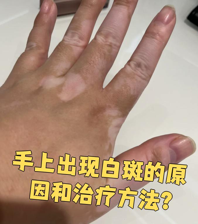手上出现白斑,常见的原因是炎症后色素减退和白癜风
