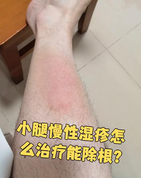 小腿慢性湿疹很难彻底除根,但可以通过治疗控制症状