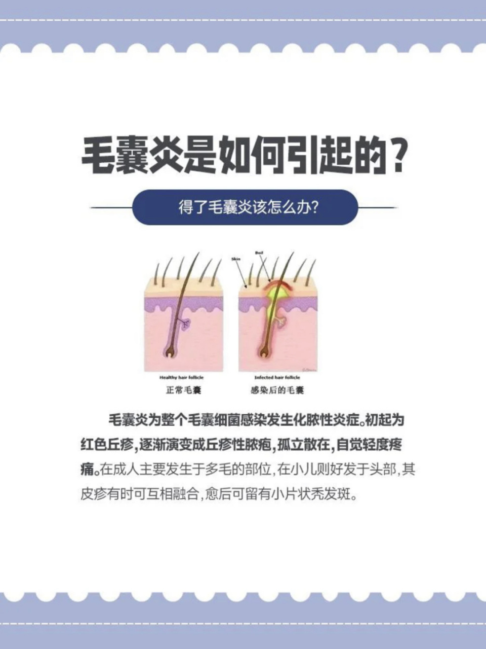 得了毛囊炎该怎么办?