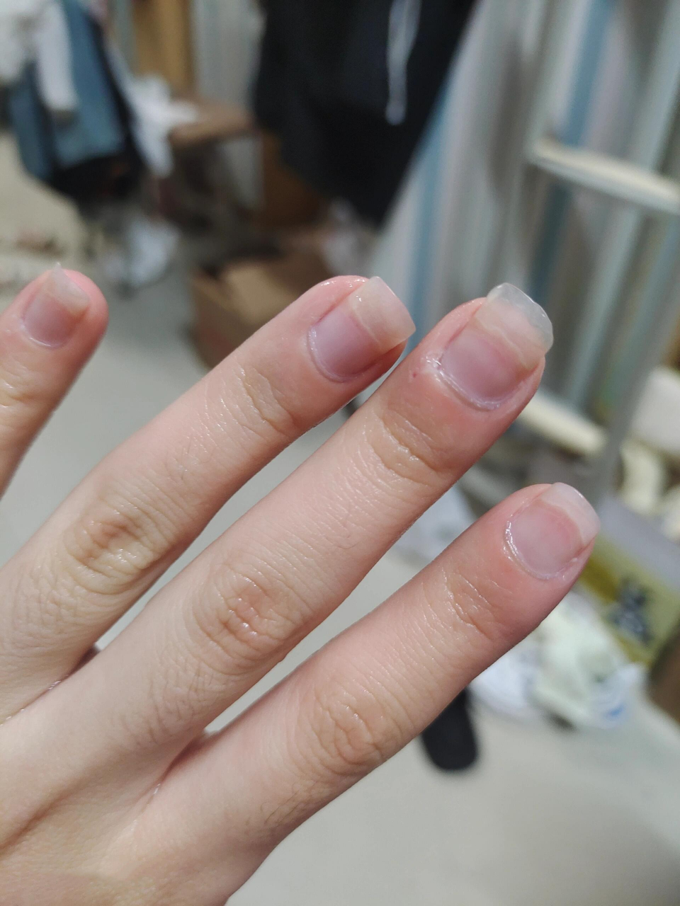 指甲不往肉里长怎么办 小时候爱咬指甲,一直以来指甲都是秃秃的 现在