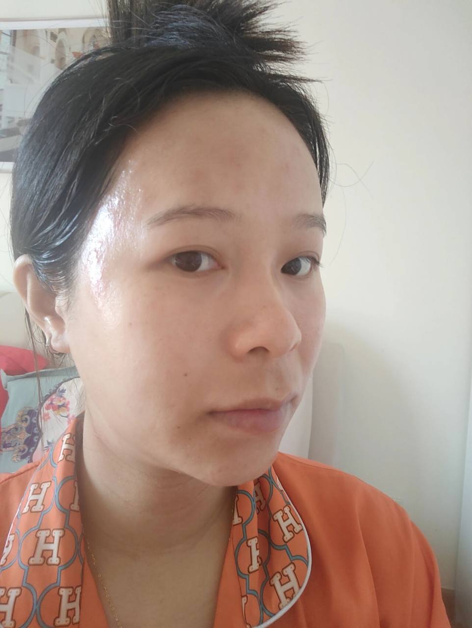 孕期皮肤过敏 没脸见人了.