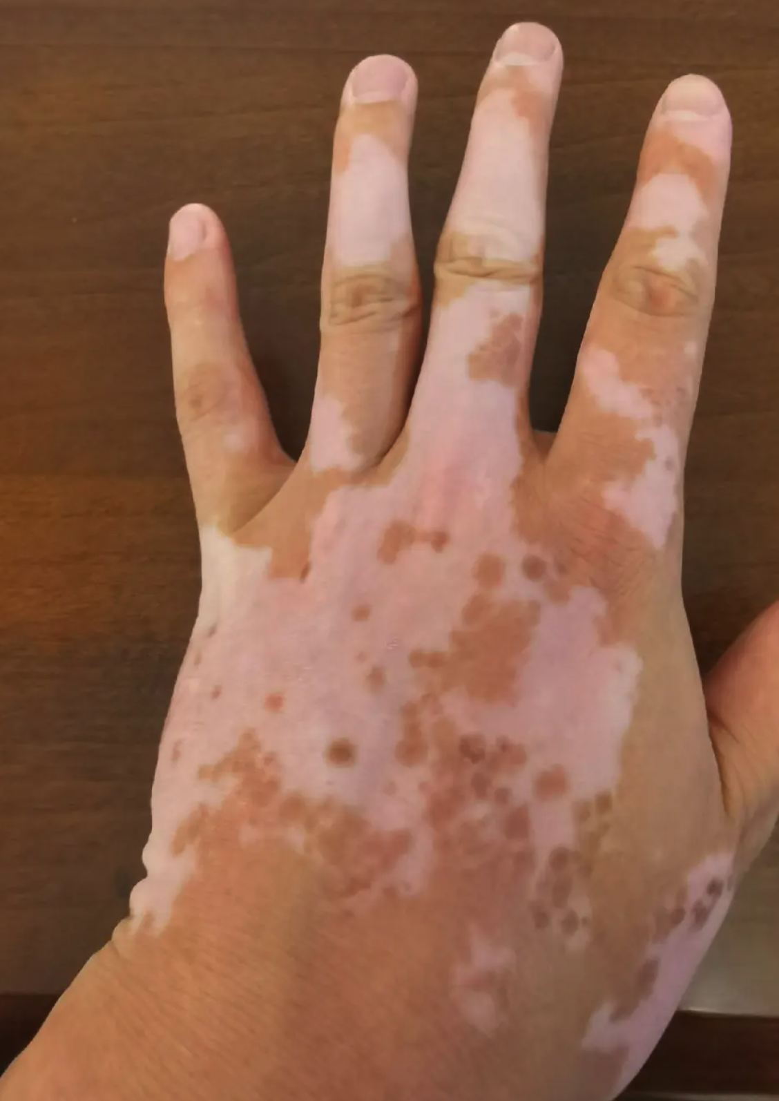 白癜风患者擦药时要注意方法