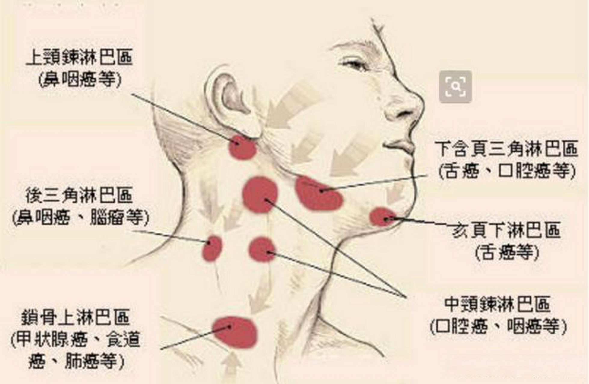 颈部淋巴结瘤的图片图片