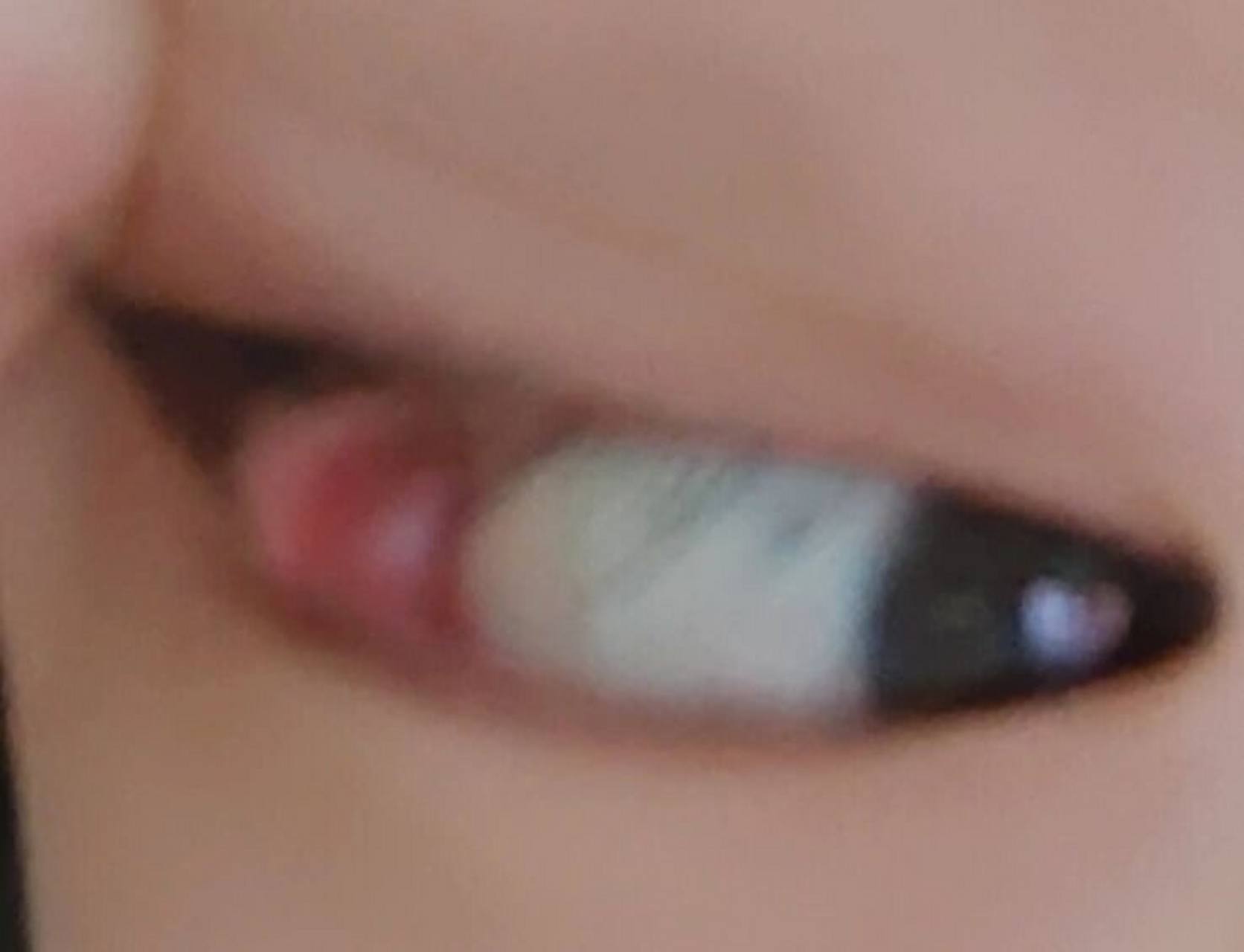 一个白色的包是什么情况 昨天发现眼睛里长了一个包包,然后眼皮肿肿的