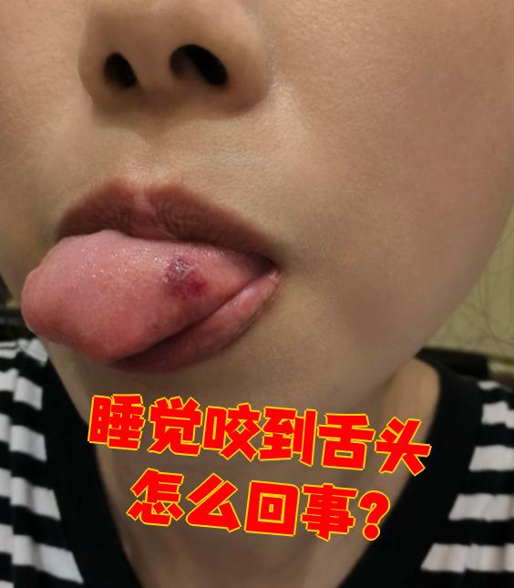 睡觉咬到舌头很常见,可能是正常情况,也可能是生病引起的
