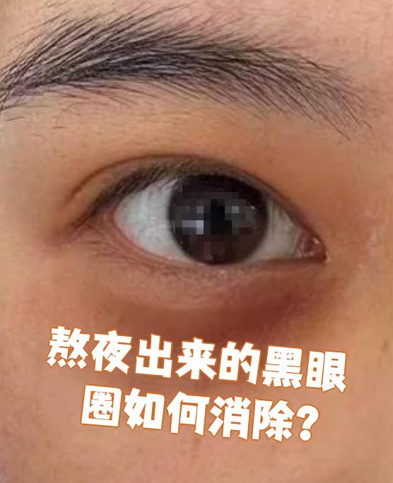 熬夜导致的黑眼圈可以试试这些方法:休息,热敷,激光治疗,强脉冲光