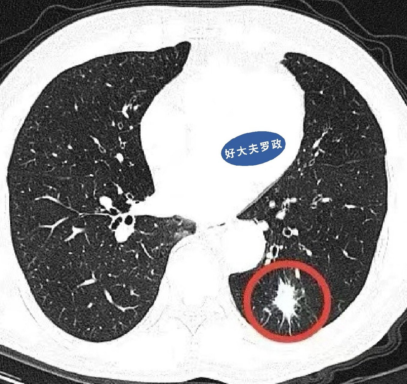 肺部结节有毛刺图片