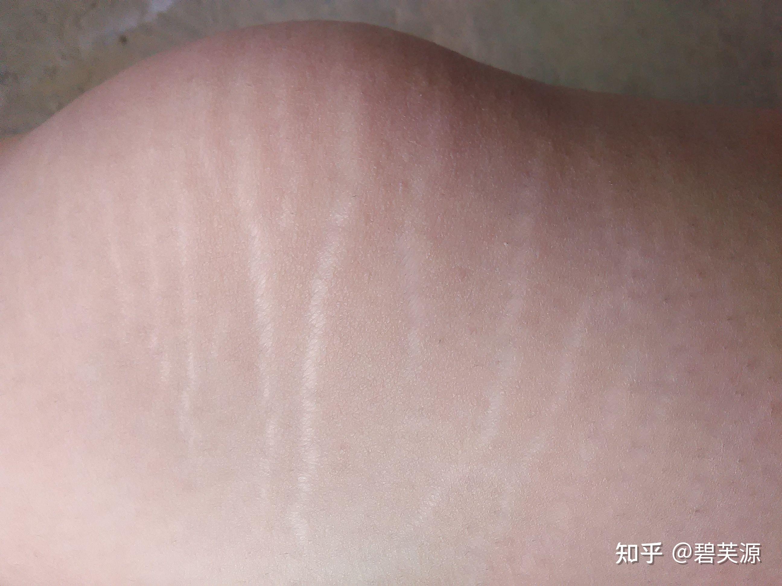 腿上的白色条纹是怎么回事都是生长纹惹的祸