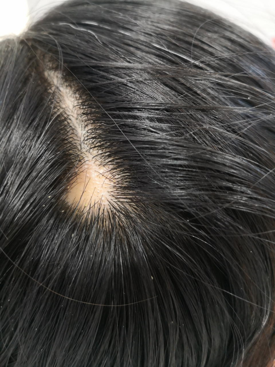 斑片状脱发症状.考虑斑秃.