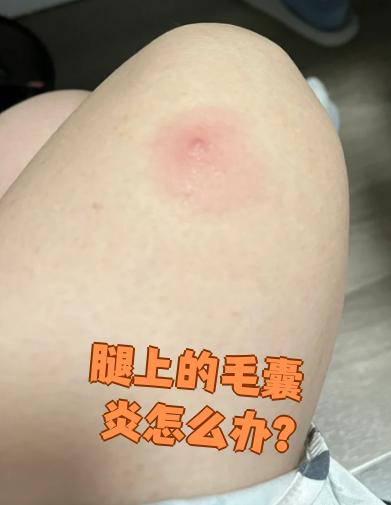 腿上出现毛囊炎可以这样处理: