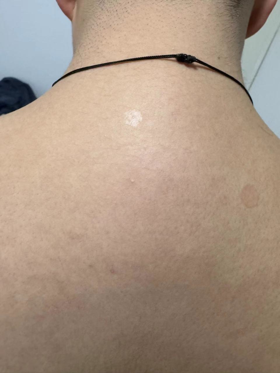 覆细碎皮屑.考虑花斑癣症状.#汗斑##解决皮肤问题专注皮肤美容