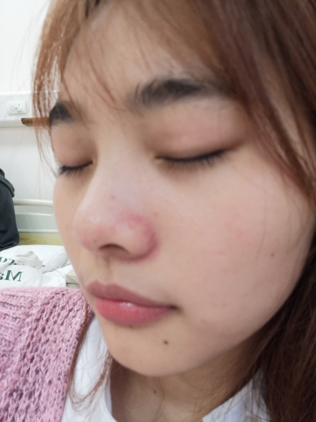 鼻翼两侧长红血丝,屏障受损 本人之前是干皮,皮肤除了有点黑之外还是