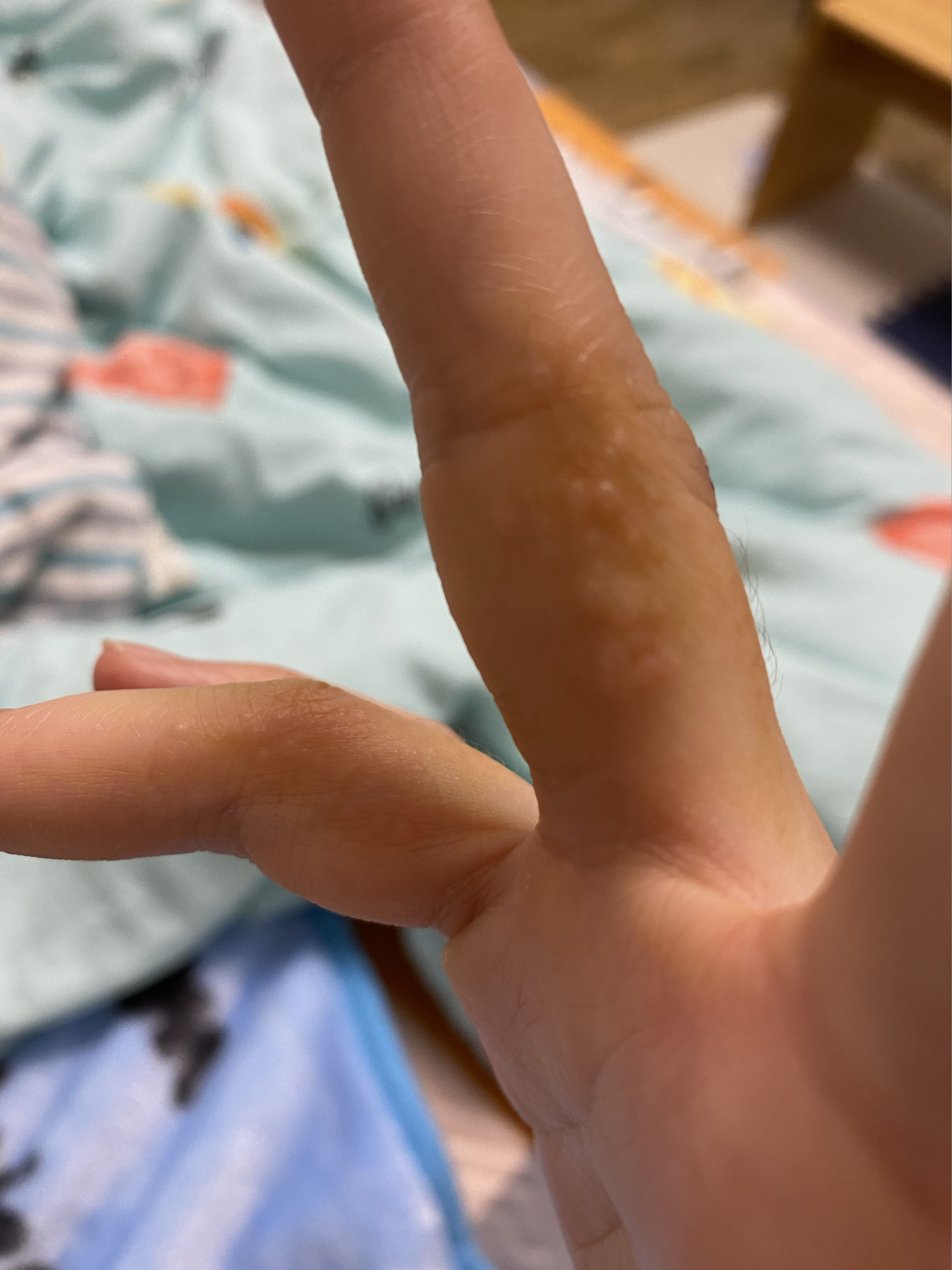 求助创可贴过敏了应该怎么办 起了好多小水泡 而且也传染了旁边的手机