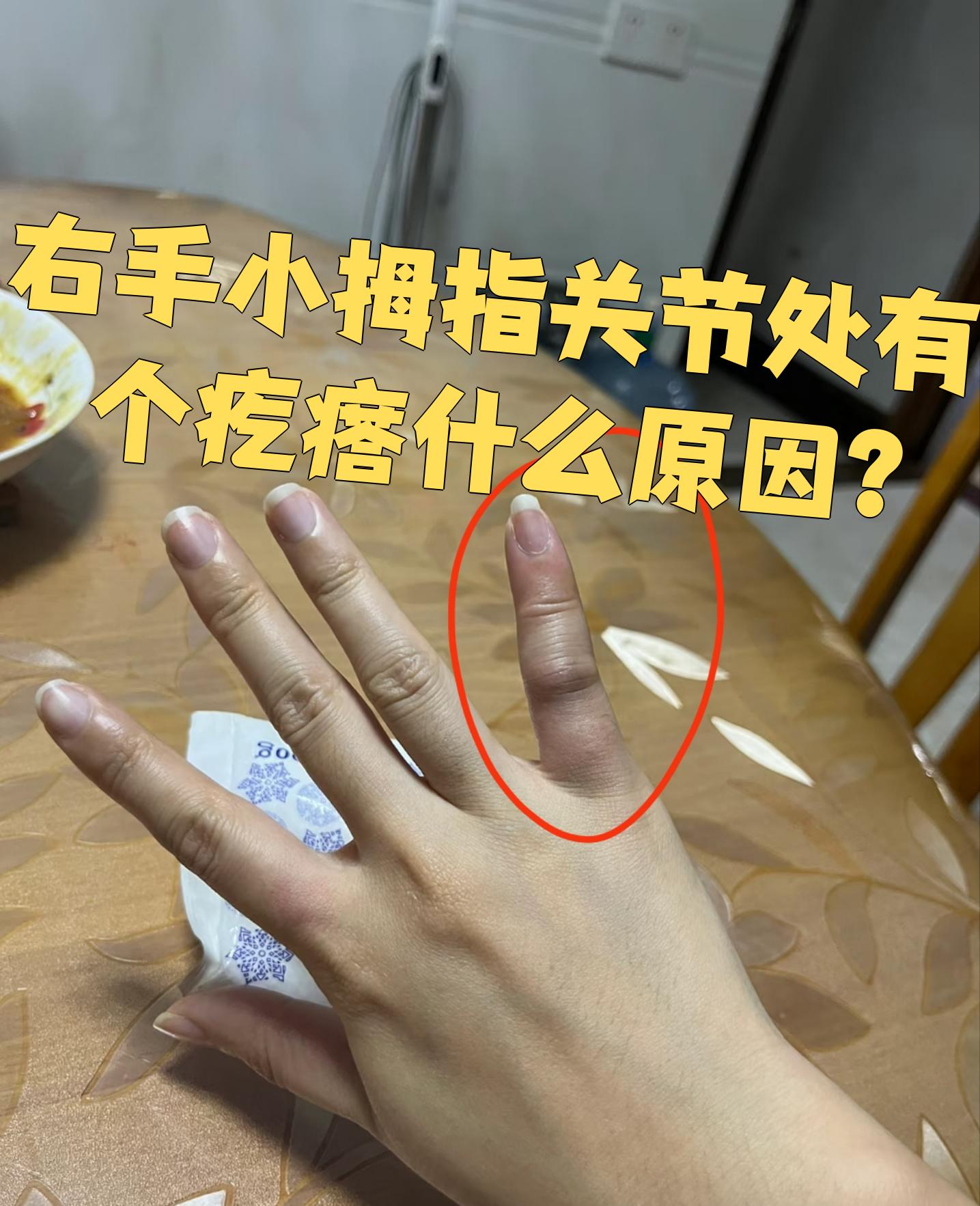 右手小拇指关节处出现疙瘩,可能和关节脱位,腱鞘炎或腱鞘囊肿有关