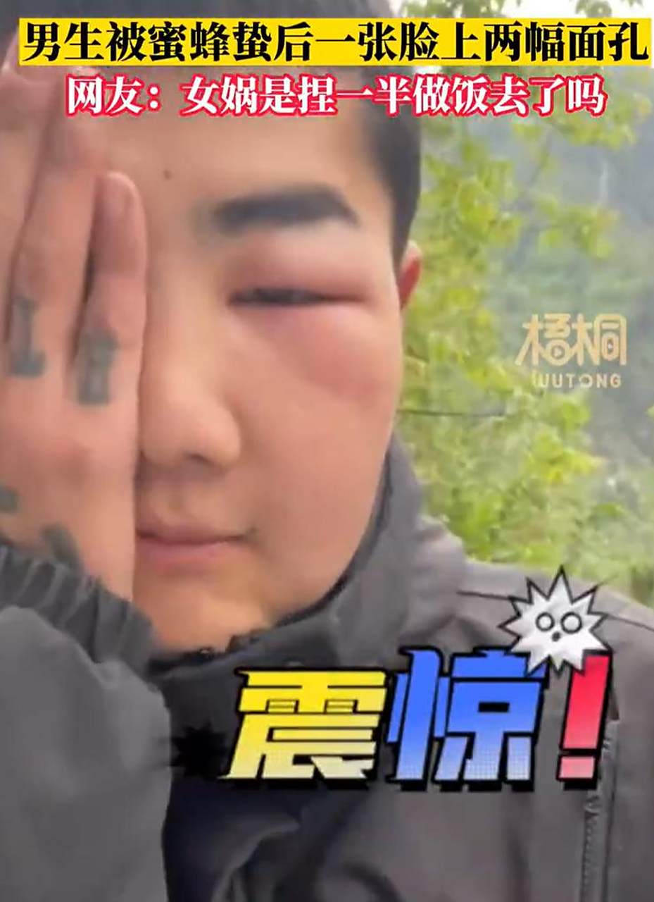 一男生不小心被蜜蜂蛰到脸,结果半边脸正常半边脸高高肿起简直判若