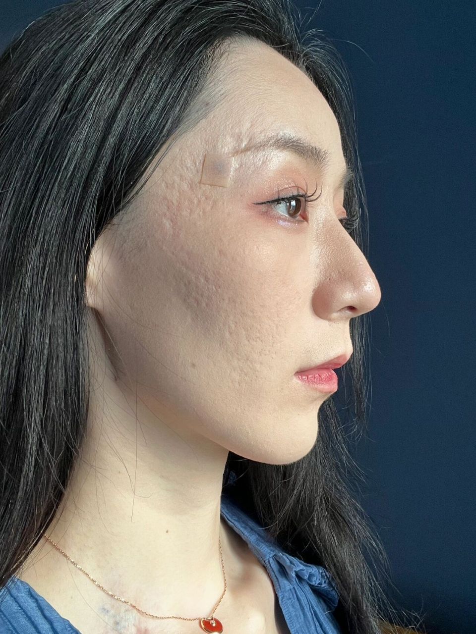 痘坑|今天取消了人工真皮填充 因为在香港发现更好的方案啦 [爱你]