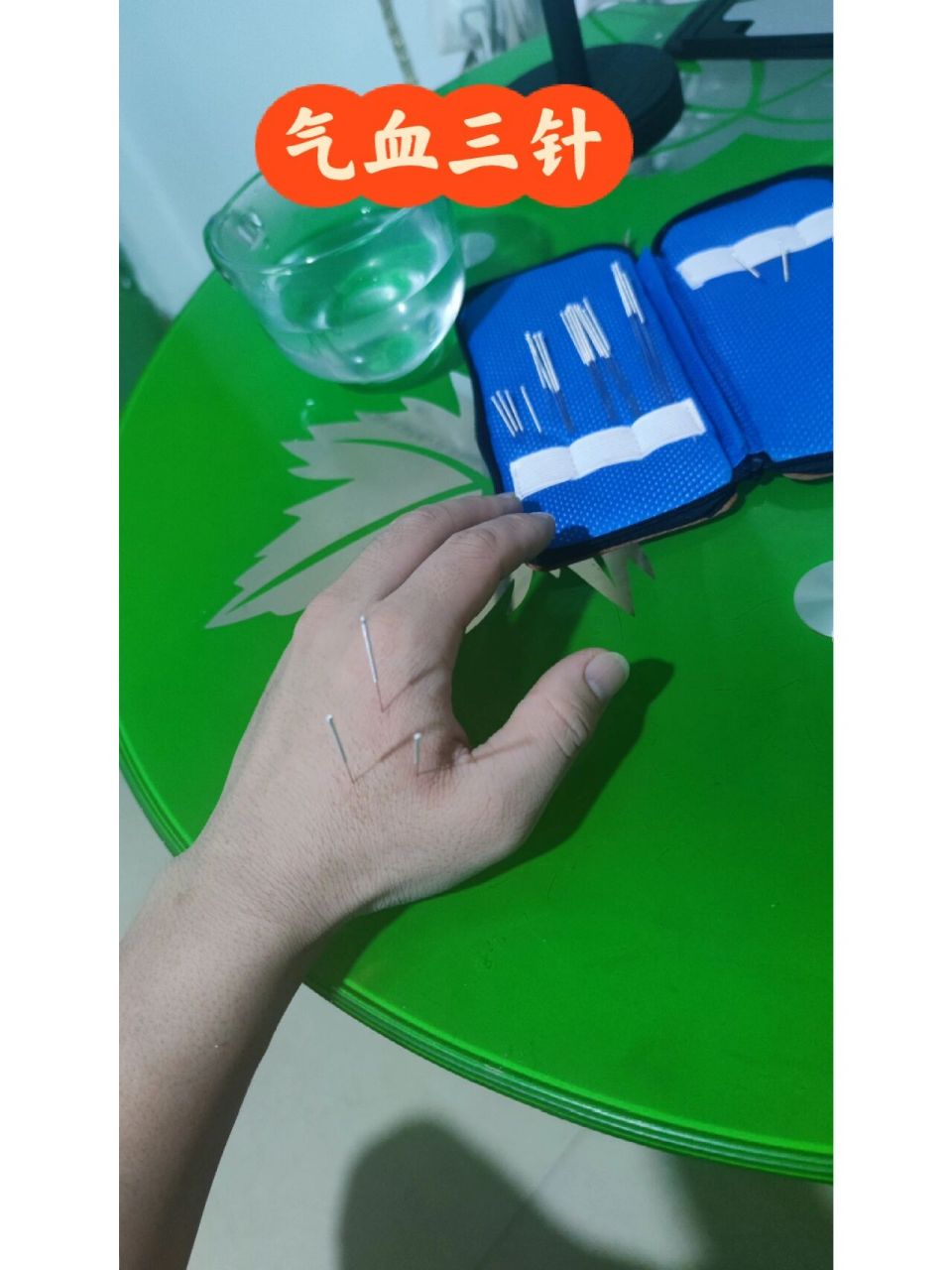 气血三针 今天扎气血三针,不确定留针多久,十几分钟后就起针了,有专业